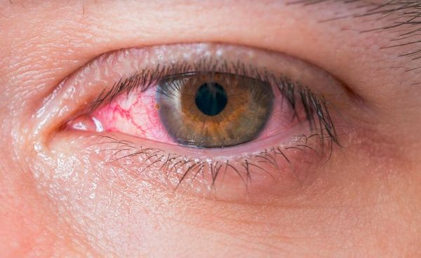 Túlhordott kontaktlencse okozta szemgyulladás